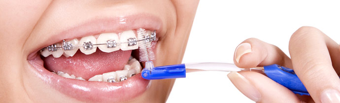 Как ухаживать за зубами с брекетами?