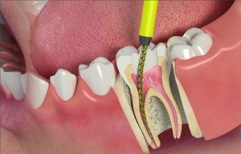 Как лечат корневые каналы зубов